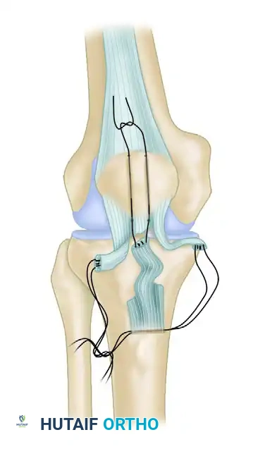 REPAIR WITH SUTURE THROUGH PATELLAR DRILL HOLES Surgical Diagram