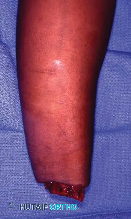 Extremity Replantation: Principles, Surgical Techniques, and Functional Outcomes