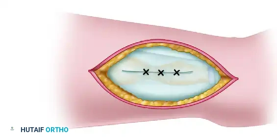 RESECTION OF THE DISTAL ULNA Surgical Diagram