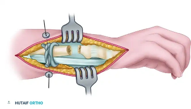 Running removable wire Ulna