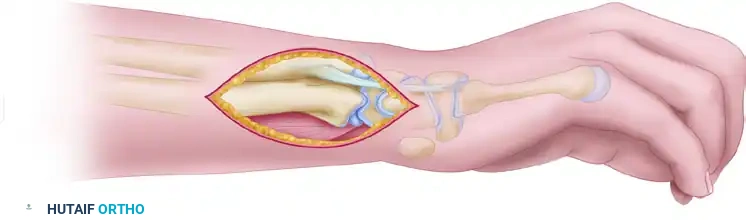 RESECTION OF THE DISTAL ULNA Surgical Diagram