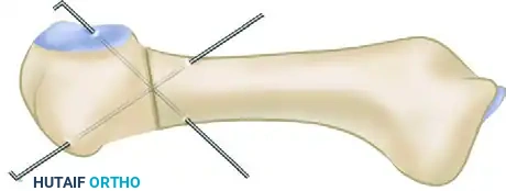 RESECTION OF THE FIFTH METATARSAL HEAD FOR BUNIONETTE DEFORMITY Surgical Diagram