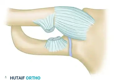 Medial Clavicle Resection for Chronic Sternoclavicular Joint Dislocation