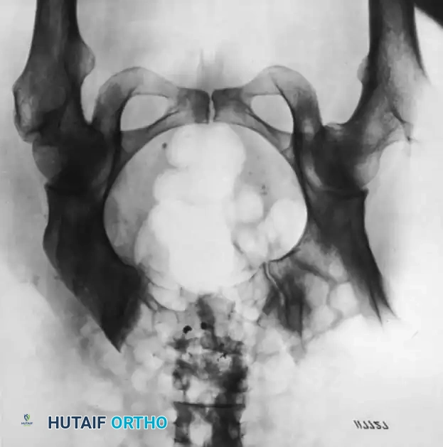 رسم توضيحي آخر يكمل خطوات استئصال عظم الشظية