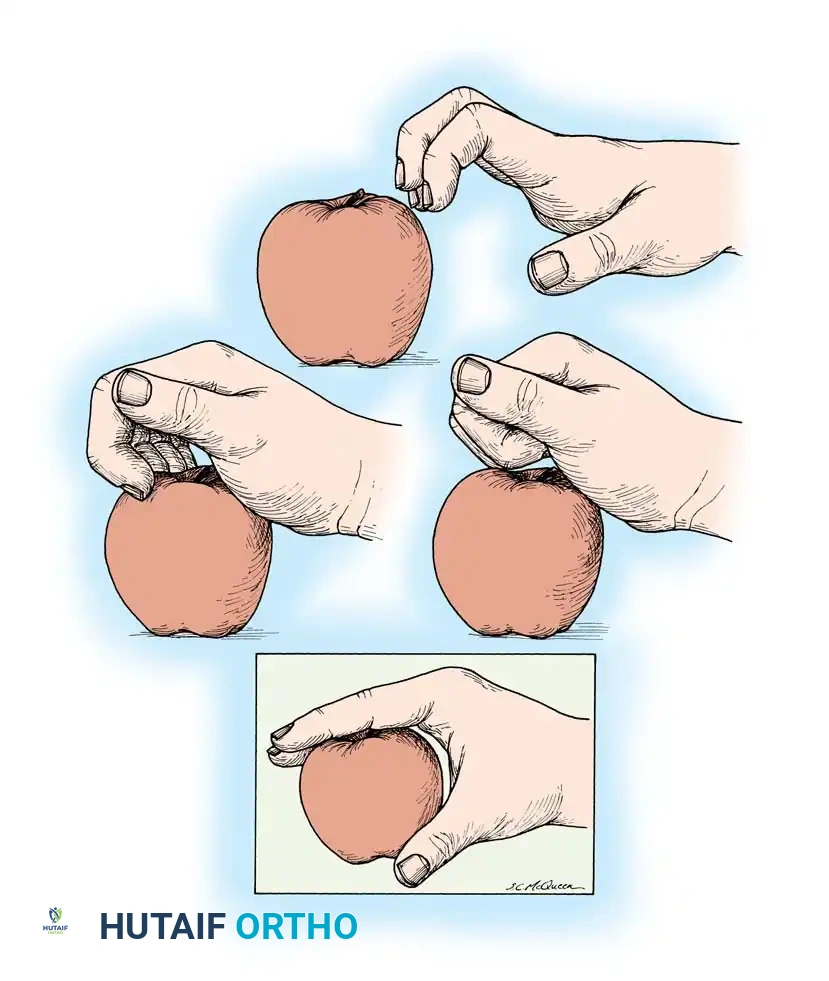 Fig. 68-17 Intrinsic muscle palsy. Flexion of metacarpophalangeal joints occurs only after interphalangeal joints are fully fl exed.