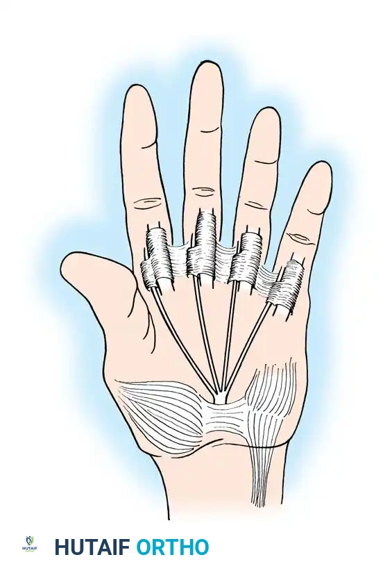 Fig. 68-18 Modifi cation of Bunnell transfer to restore intrinsic function of fi ngers