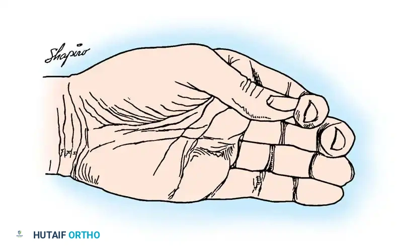Fig. 68-22 Brand transfer of extensor carpi radialis brevis tendon prolonged with free graft