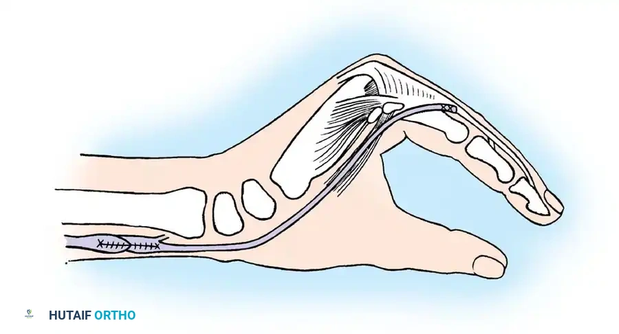 Fig. 68-24 Brand transfer of extensor carpi radialis longus or brevis, fi rst to volar side of forearm