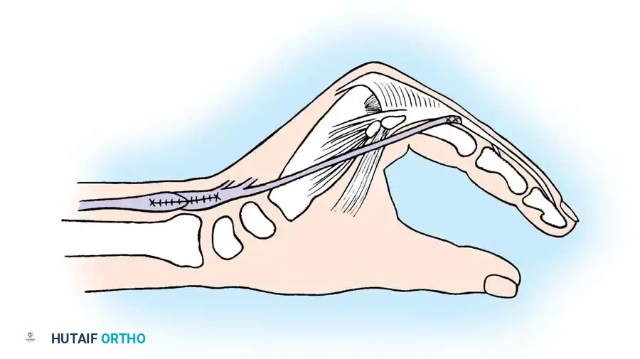 Fig. 68-22 Brand transfer of extensor carpi radialis brevis tendon prolonged with free graft