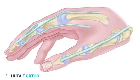 RESTORATION OF PINCH Surgical Diagram