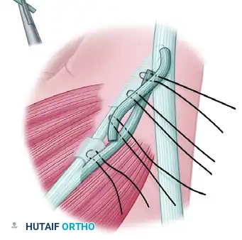 RESTORATION OF PINCH Surgical Diagram