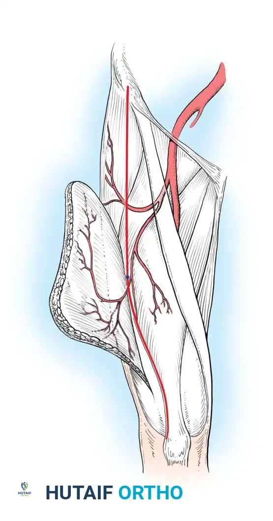 Revascularization and Free Tissue Transfer in Orthopaedic Surgery