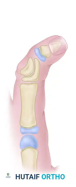 Reverse Wedge Osteotomy and Management of Madelung Deformity