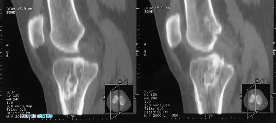 REVISION ANTERIOR CRUCIATE LIGAMENT SURGERY Surgical Diagram