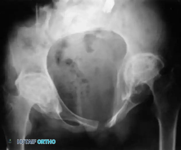 تأثير التهاب المفاصل الروماتويدي اليفعي على مفصل الورك وتشوه رأس الفخذ