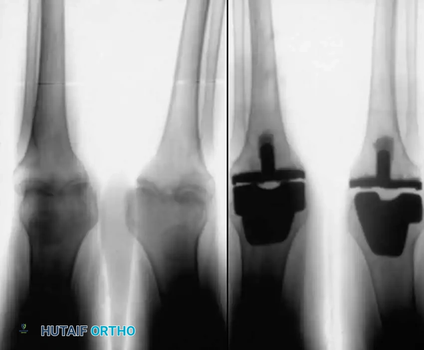 استبدال مفصل الركبة بالكامل لعلاج التهاب المفاصل الروماتويدي المتقدم