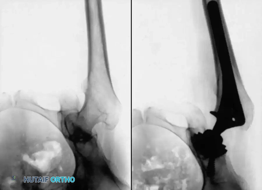 استبدال مفصل الورك بالكامل لمريض يعاني من التهاب المفاصل الروماتويدي