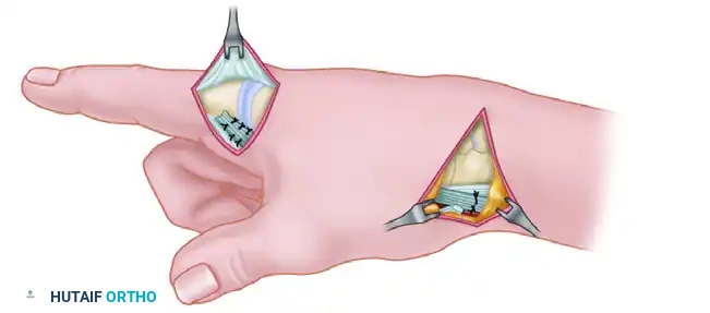 Masterclass in Tendon Transfers for Thumb Intrinsic Dysfunction: Modified Royle-Thompson and EIP Techniques