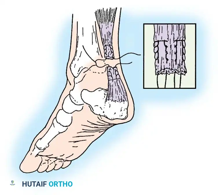 RUPTURE OF MUSCLES AND TENDONS Surgical Diagram