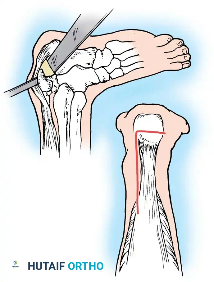 Masterclass in Operative Orthopaedics: Muscle and Tendon Ruptures