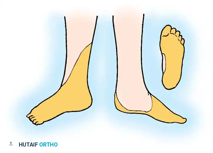 Fig. 59-36 Autonomous zone of sciatic nerve.