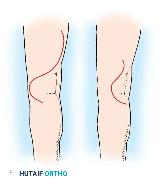 Distal exposure of the sciatic nerve