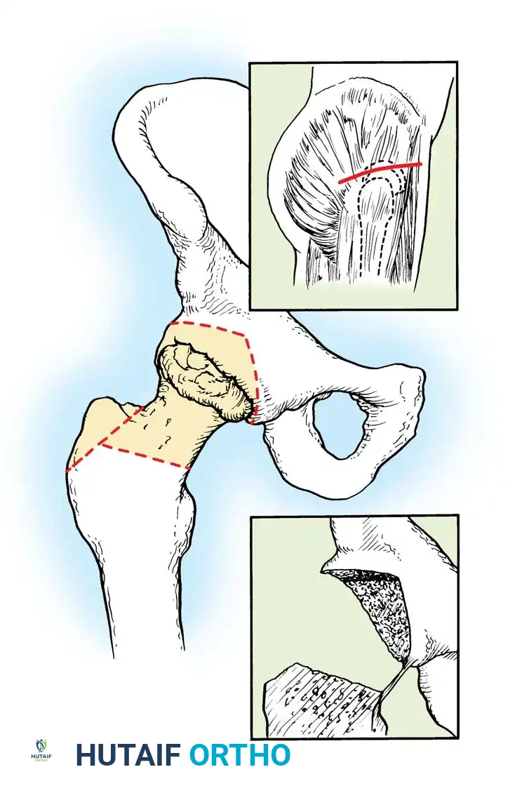 SACROILIAC JOINT Surgical Diagram