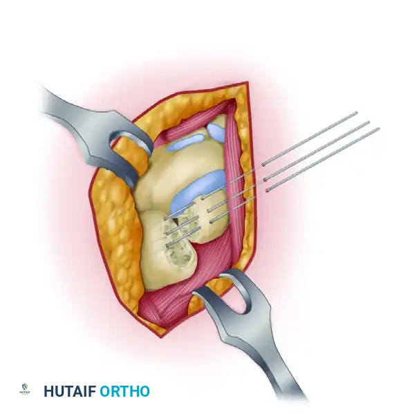 SCAPHOCAPITATE ARTHRODESIS Surgical Diagram