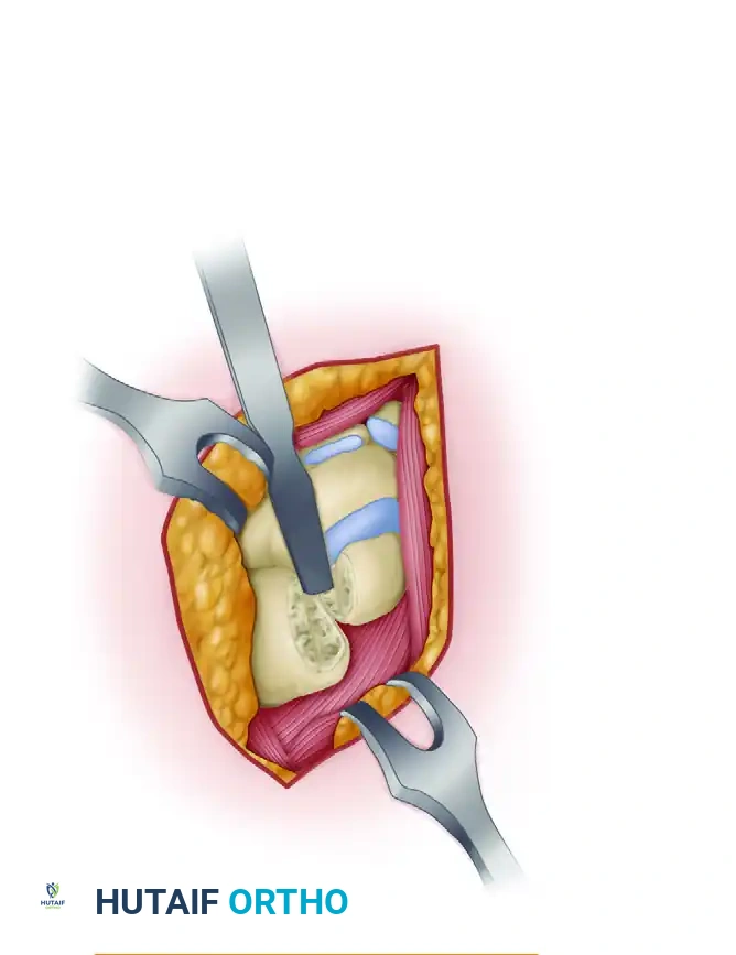 SCAPHOCAPITATE ARTHRODESIS Surgical Diagram