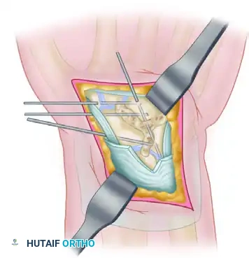 Fixation with Kirschner Wires