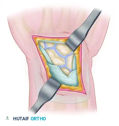 Scaphocapitolunate Articulation Exposed
