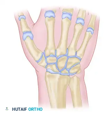 Skin Incision for Scaphocapitolunate