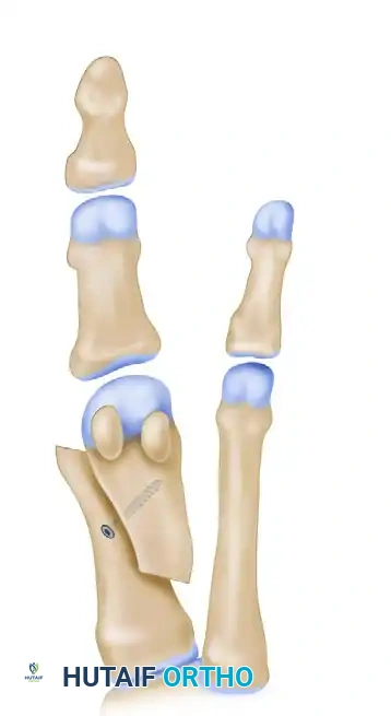 تشريح القدم وموقع التشوه