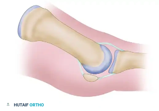 تفاصيل القطع العظمي في المشطية الأولى