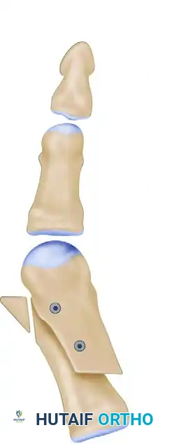 الزوايا التشريحية قبل التدخل الجراحي