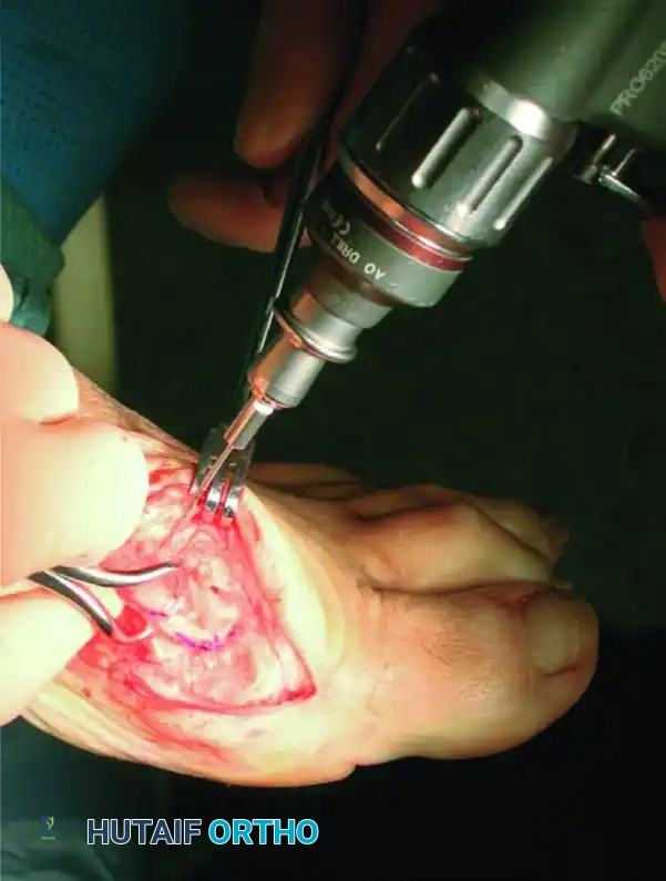 قياس الزوايا التشريحية بدقة