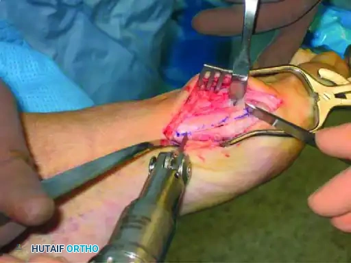 تأثير التشوه على المفاصل المجاورة