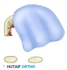 التعامل مع الأنسجة الرخوة والأربطة