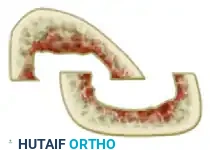 تعديلات حديثة على التقنية الجراحية