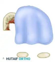 ظاهرة التخندق العظمي وكيفية تجنبها