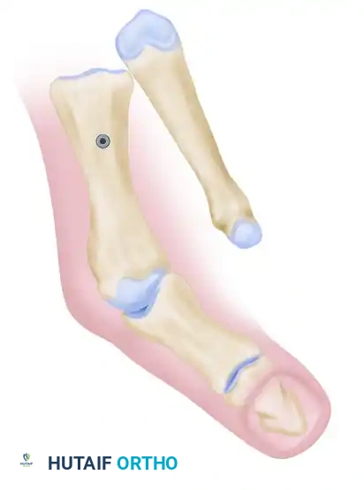 بدء العلاج الطبيعي والتأهيل الحركي