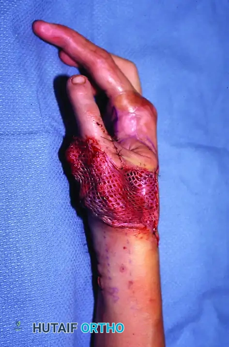 Second or Third Toe Transplantation: Advanced Microsurgical Reconstruction