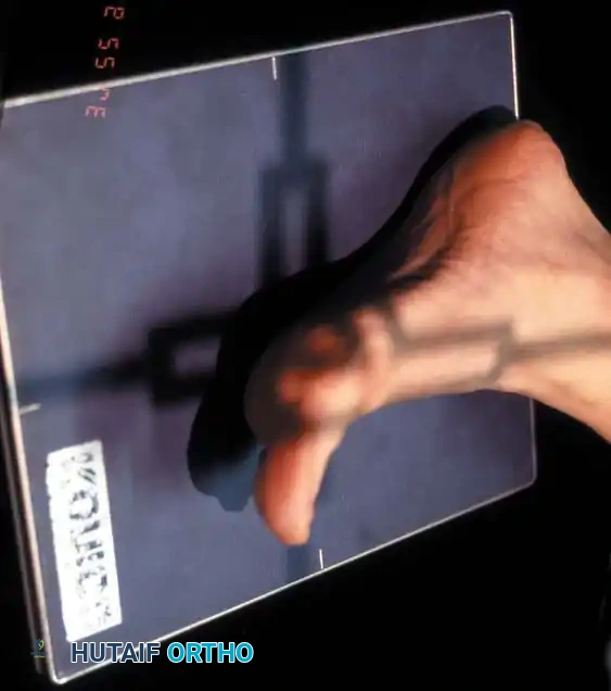 SESAMOID INJURIES OF THE HALLUX Surgical Diagram