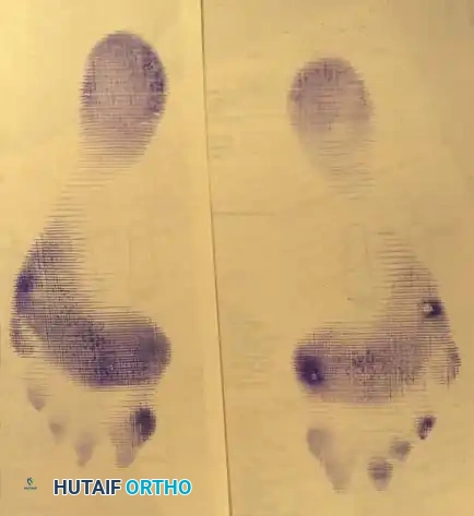 Fig. 78-99 A and B, Plantar fl exed fi rst ray with callus beneath tibial sesamoid. C, On Harris pressure mat, note increased pressure beneath tibial sesamoid. D, Tibial sesamoid has been removed, and articular surface and corresponding facet of metatarsal head show degenerative changes.