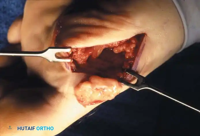 Fig. 78-99 A and B, Plantar fl exed fi rst ray with callus beneath tibial sesamoid. C, On Harris pressure mat, note increased pressure beneath tibial sesamoid. D, Tibial sesamoid has been removed, and articular surface and corresponding facet of metatarsal head show degenerative changes.