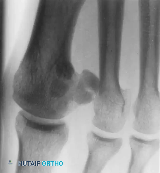 SESAMOID INJURIES OF THE HALLUX Surgical Diagram