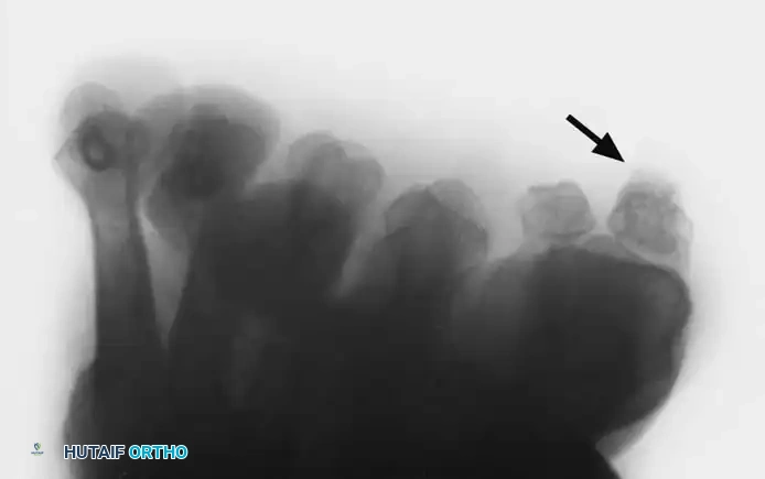 Fig. 78-102 A, Exostosis on plantar surface of tibial sesamoid. B, Patient had keratotic lesion with intermittent ulceration. Excision of sesamoid is indicated.