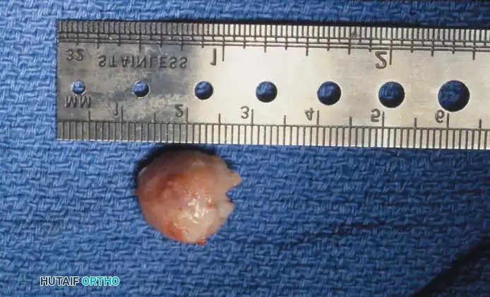 Fig. 78-102 A, Exostosis on plantar surface of tibial sesamoid. B, Patient had keratotic lesion with intermittent ulceration. Excision of sesamoid is indicated.