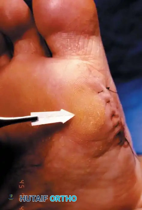 Fig. 78-104 Diffuse keratosis that persisted over protracted period and was unresponsive to nonoperative management.