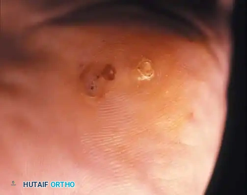 Fig. 78-103 A and B, Persistent keratotic lesion and bursa beneath tibial sesamoid. C, Sesamoid and overlying bursa removed. Radiographs, including axial sesamoid view, were normal.